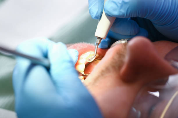 Best Broken or Chipped Tooth Repair in Vinco, PA